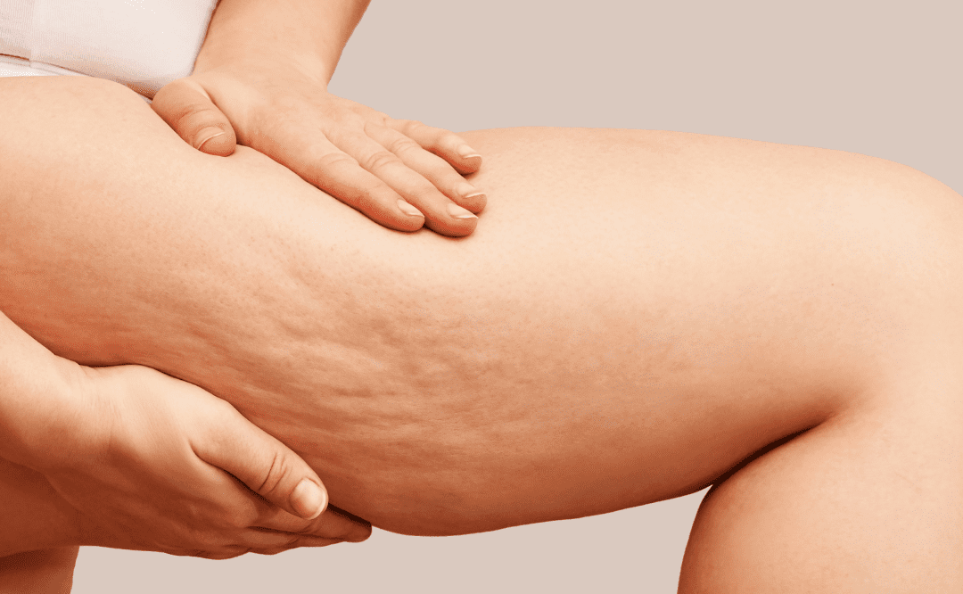 Cellulite : peau ondulée sur le corps